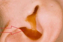 Bài thuốc Đông y trị viêm tai giữa