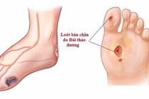 Kiểm soát biến chứng nặng của tiểu đường 