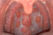 Nhận biết sớm viêm họng hạt 