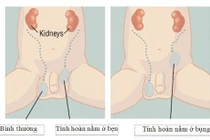 Tinh hoàn lò xo không điều trị thành tinh hoàn ẩn