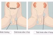 Tinh hoàn lò xo không điều trị thành tinh hoàn ẩn