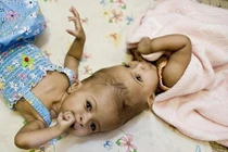 Ca phẫu thuật tách cặp song sinh dính liền đầu diễn ra như thế nào?