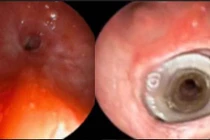 Cấp cứu bệnh nhân suy hô hấp cấp do hẹp khí quản