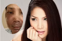 Hồng Ngọc lần đầu công khai hình ảnh khuôn mặt bị bỏng đến 2/3 và chia sẻ điều xúc động