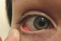 Không được coi thường dị vật bay vào mắt