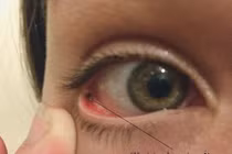 Không được coi thường dị vật bay vào mắt