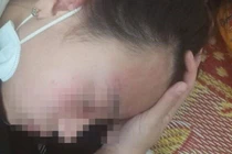 Đi mua kim, nữ sinh lớp 10 bị đánh chấn động não