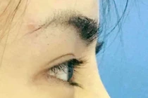 Những điều cần biết khi phẫu thuật nâng mũi