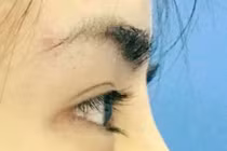 Những điều cần biết khi phẫu thuật nâng mũi