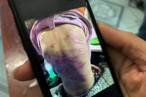 Hà Nội yêu cầu điều tra vụ bé gái 12 tuổi bị mẹ bạo hành