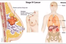 Các loại ung thư di căn tới vú