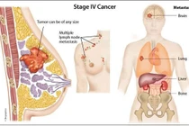 Các loại ung thư di căn tới vú
