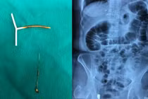 Vòng tránh thai mắc trong đại tràng