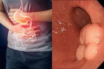 Tùy tiện dùng thuốc "chuốc" ung thư dạ dày 