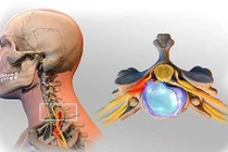 Đau mỏi cổ, tê cứng tay do hẹp ống sống cổ