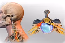 Đau mỏi cổ, tê cứng tay do hẹp ống sống cổ