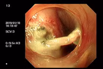 Áp xe trung thất nặng sau hóc xương 