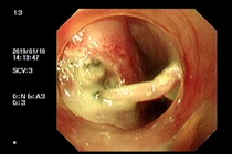 Áp xe trung thất nặng sau hóc xương 
