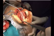 Đau nhức đùi do u đại bào