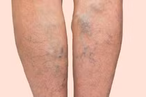 Suy giãn tĩnh mạch