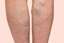 Suy giãn tĩnh mạch