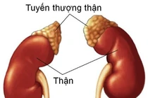 Suy tuyến thượng thận vì lạm dụng corticoid