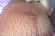  Ảnh hưởng tâm lý vì rạn da