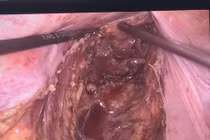 Tắc ruột do ung thư trực tràng