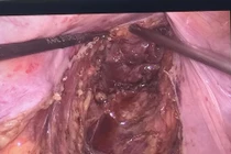 Tắc ruột do ung thư trực tràng