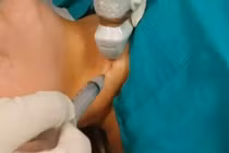 Chọc sinh thiết nhiều lần