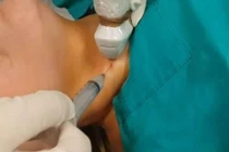 Chọc sinh thiết nhiều lần