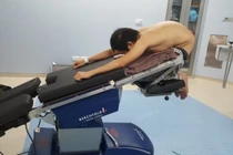 Gù nặng do viêm cột sống dính khớp 