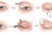 Những rủi ro khi phẫu thuật tạo hình mí mắt