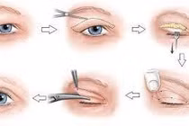 Những rủi ro khi phẫu thuật tạo hình mí mắt