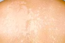 Mùa hè cẩn thận với lang ben