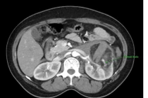 Nút mạch hạt vi cầu điều trị u cơ mỡ mạch thận vỡ