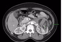 Nút mạch hạt vi cầu điều trị u cơ mỡ mạch thận vỡ