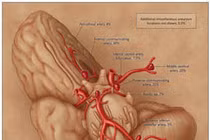 Sự ác hiểm của phình động mạch não