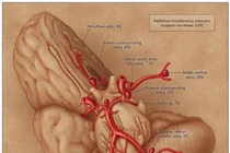 Sự ác hiểm của phình động mạch não