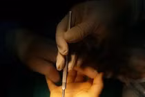 Nội soi điều trị hội chứng ống cổ tay 