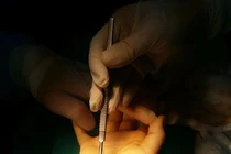 Nội soi điều trị hội chứng ống cổ tay 