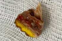 2 năm ho ra máu, giãn phế quản vì vỏ kẹo kẹt trong phổi 