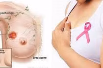 Các tổn thương vú lành tính