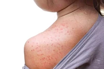 Nhiều dịch bệnh chực chờ bùng phát