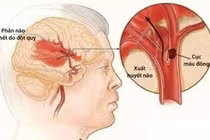 Kiểm soát tốt đột quỵ não 