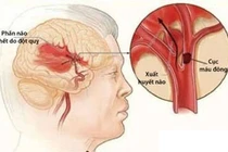 Kiểm soát tốt đột quỵ não 