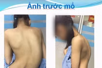 Phẫu thuật chỉnh hình cột sống cong 45 độ 