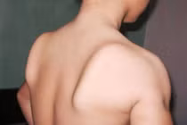 Điều trị teo cơ delta