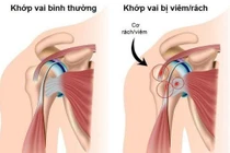 Bài tập phục hồi đau vai do viêm gân chóp xoay