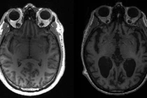Xuất hiện bệnh lạ ảnh hưởng não ở Canada 